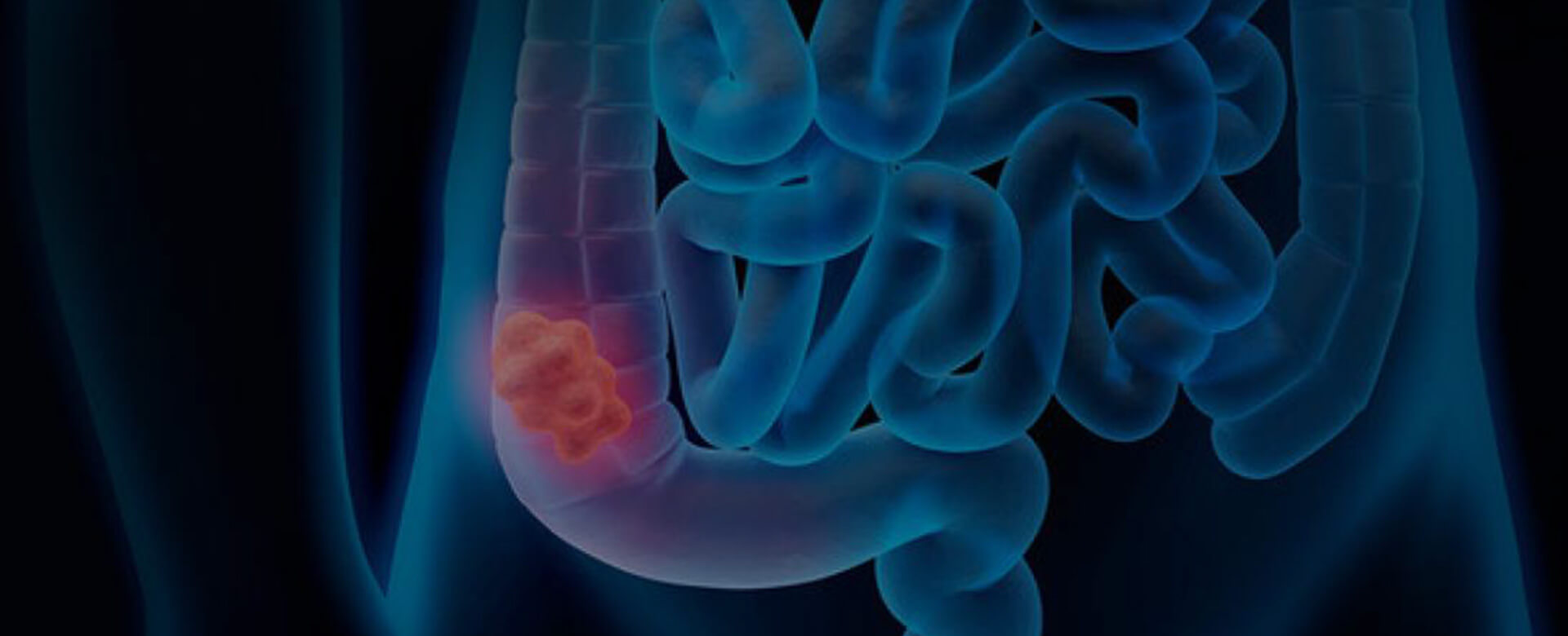 In the gut microbiota a new weapon against colon cancer